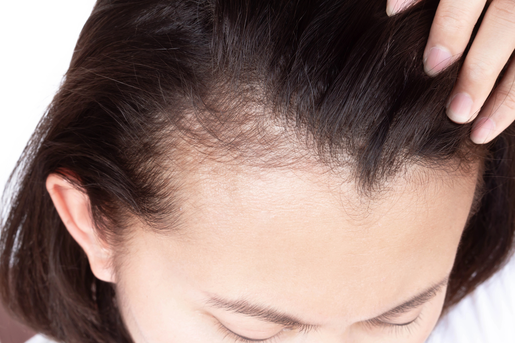 What Does A Receding Hairline Look Like On Women?