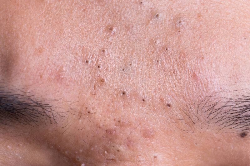 How To Remove Blackheads In 5 Minutes