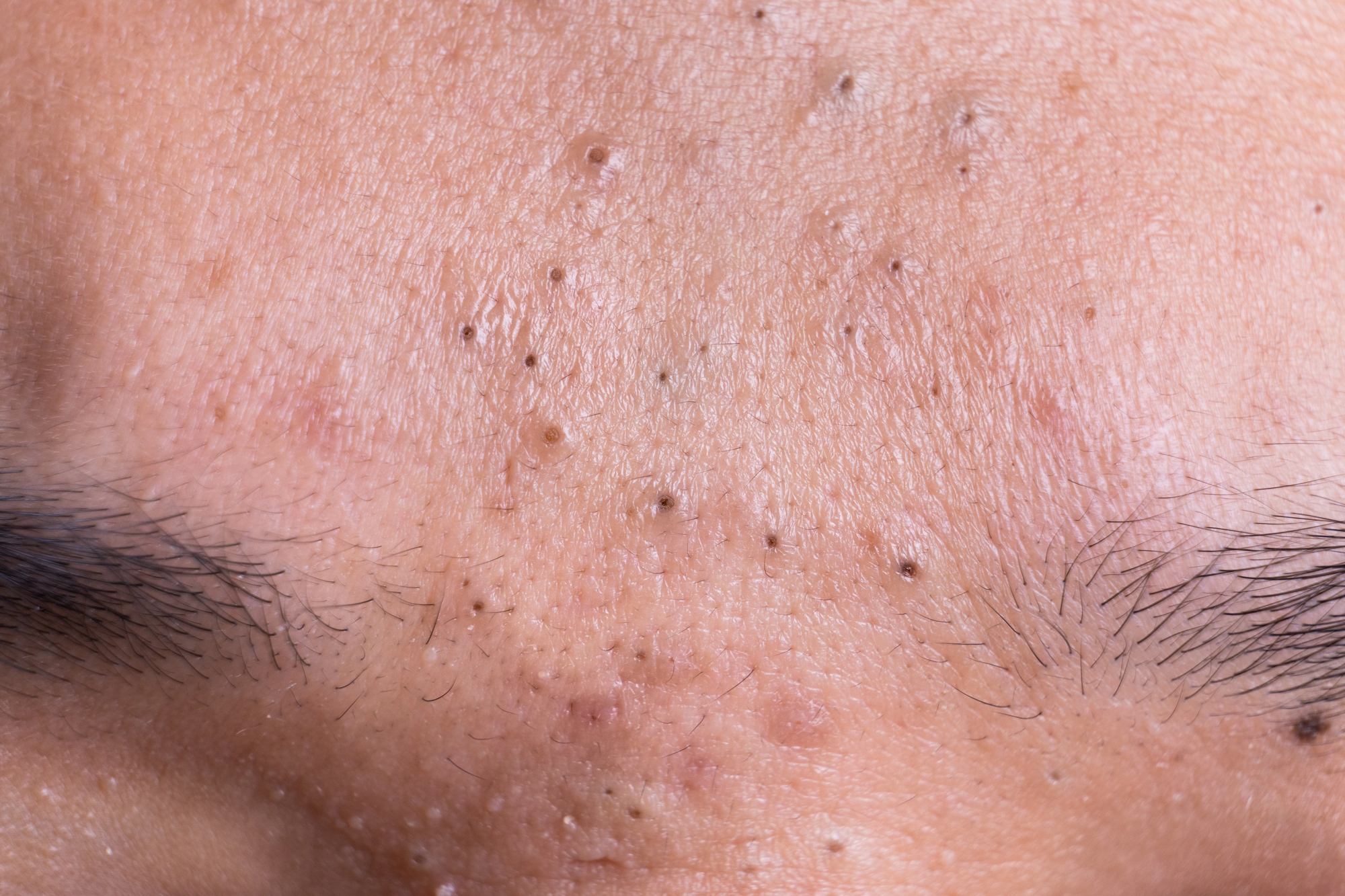 How To Remove Blackheads In 5 Minutes