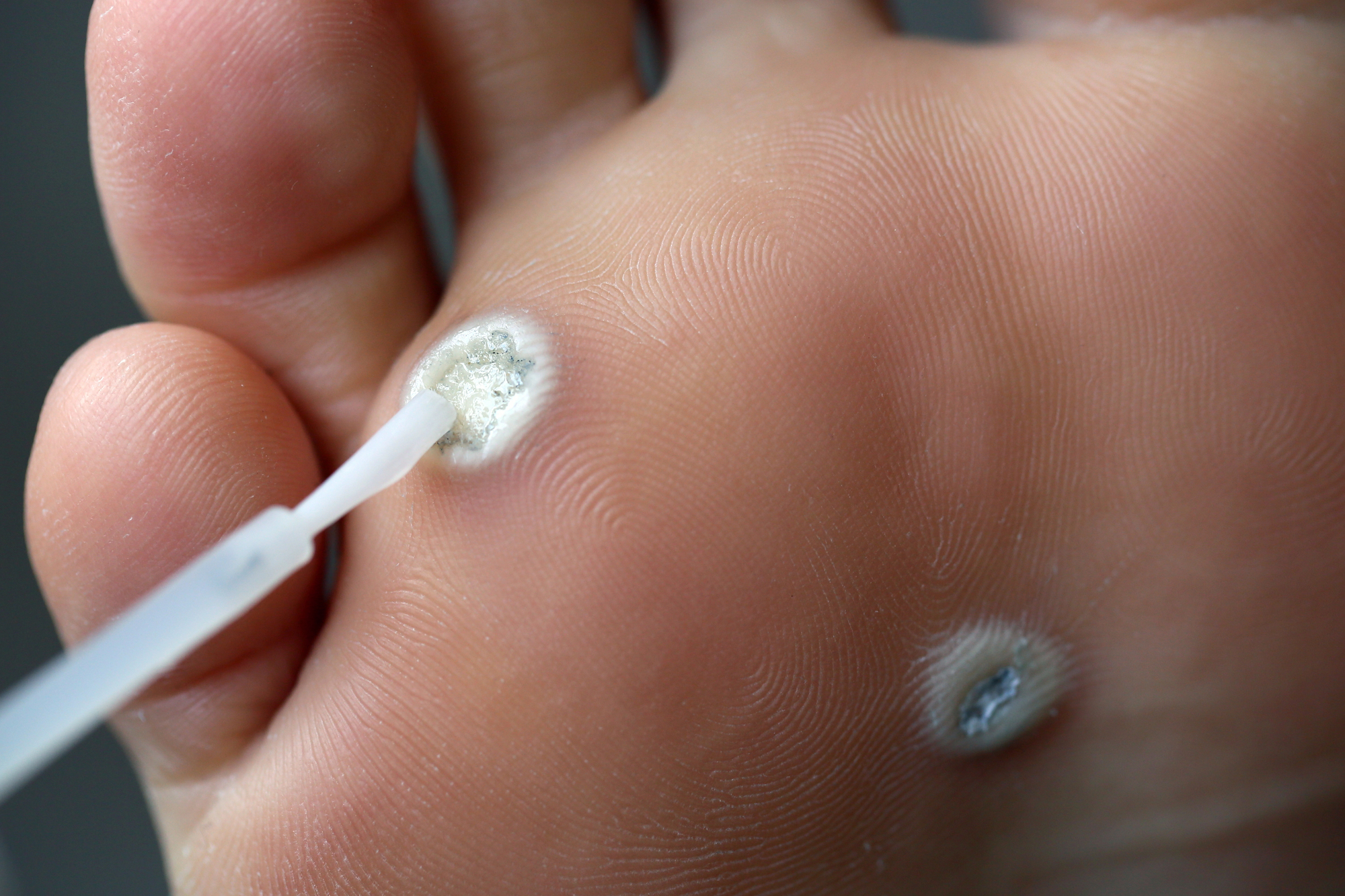 Wart Removal Products That Really Work and What to Try First