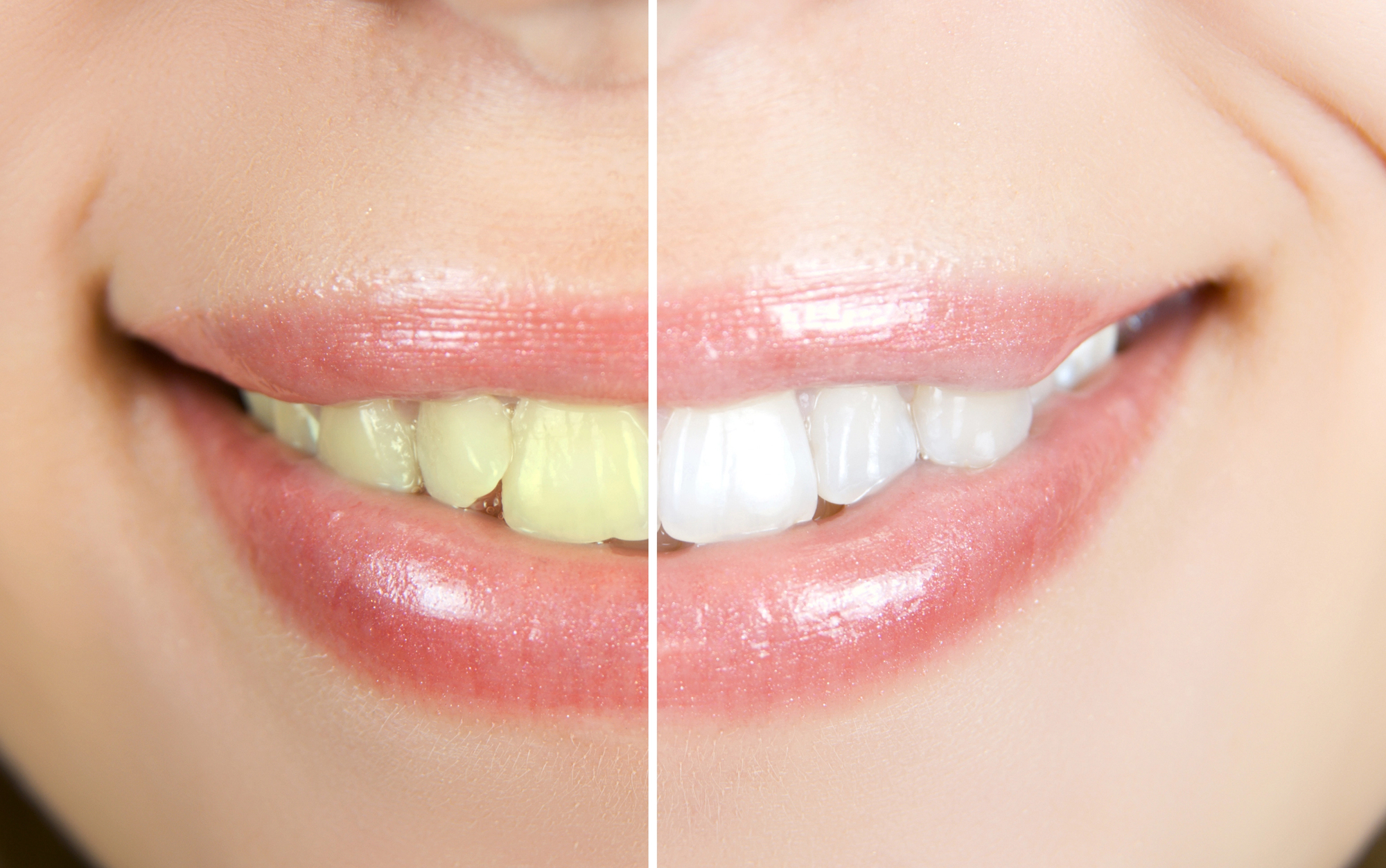 Why Laser Teeth Whitening Is Popular and What You Can Expect