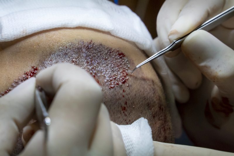 Why Some People Regret Their Hair Transplant Decision