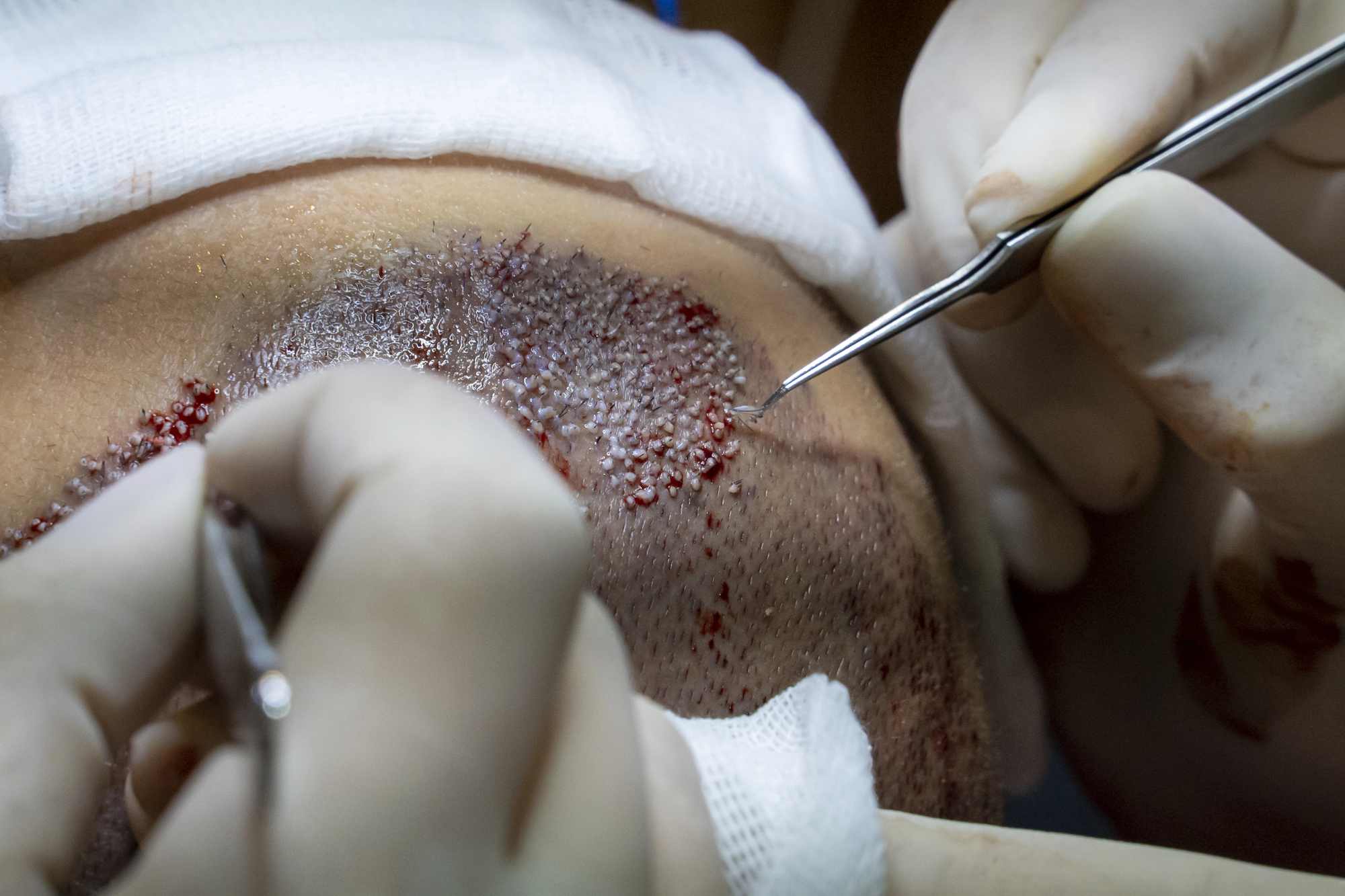 Why Some People Regret Their Hair Transplant Decision